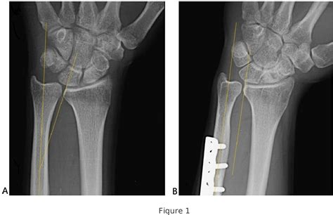 ulnar impaction syndrome grit ratio